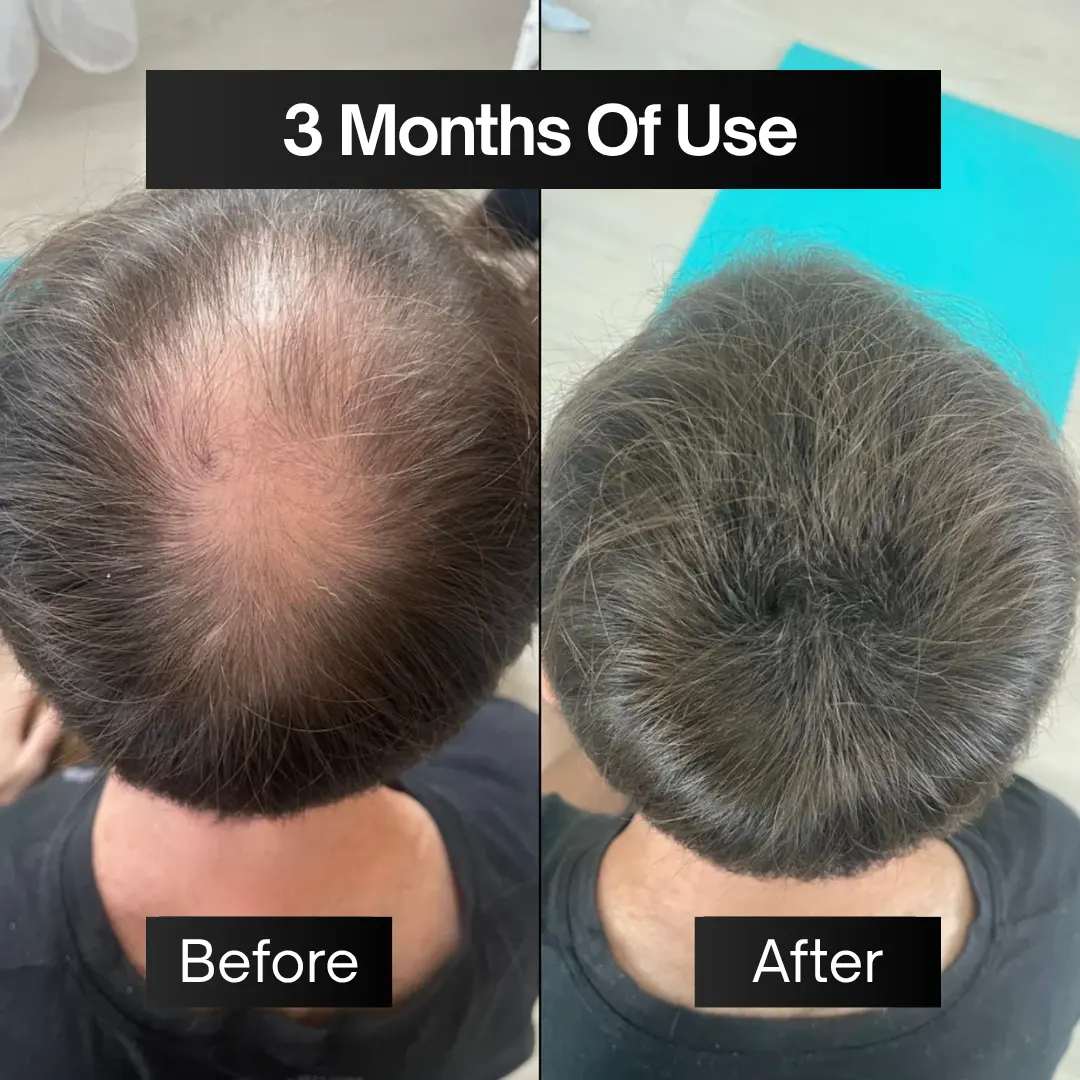 Full Pack | Hair Filler + Serum + Derma Roller - Image 3