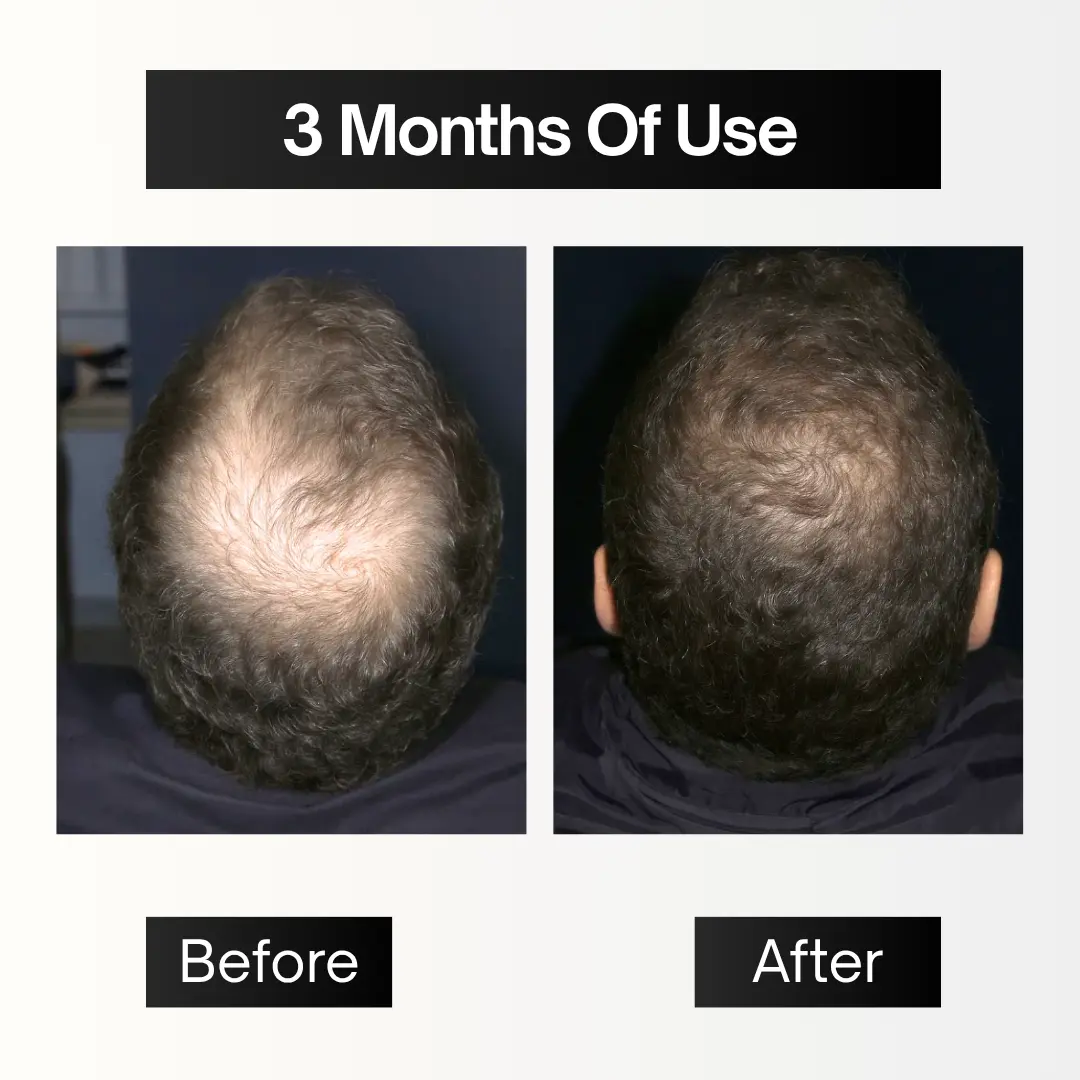 Full Pack | Hair Filler + Serum + Derma Roller - Image 5
